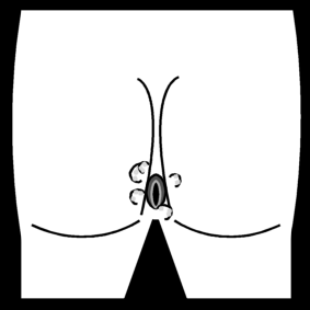 sexually transmitted disease: warts